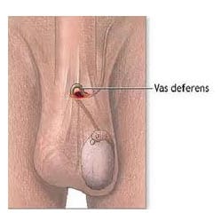 Dr. Lief’s single incision vasectomy technique